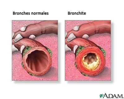sintomas de bronquiolitis en niños